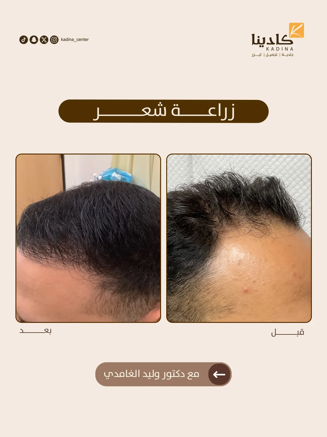زراعة شعر - د. وليد الغامدي