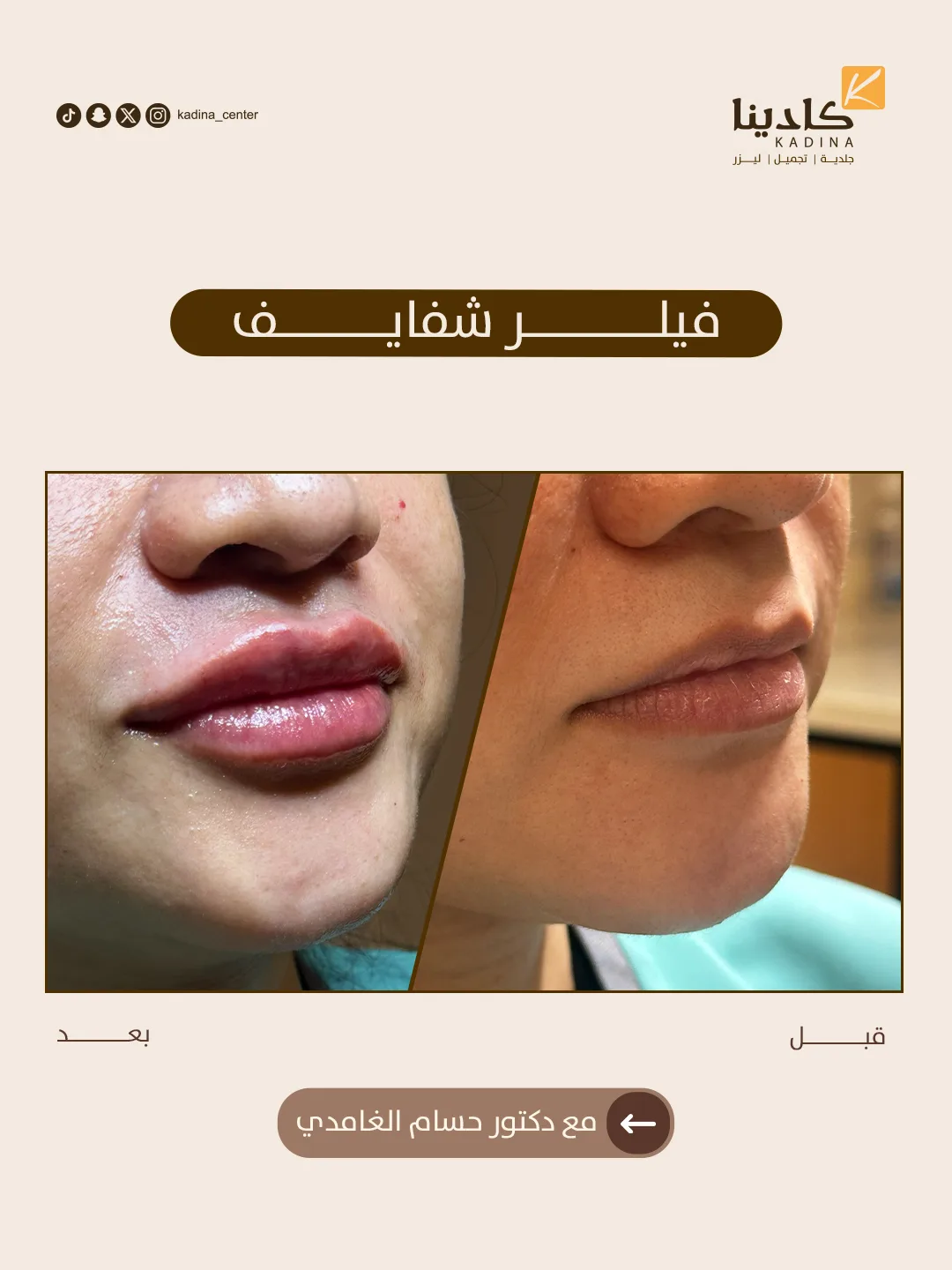 فيلر شفايف - د. حسام الغامدي