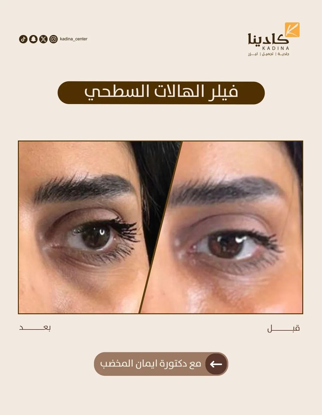فيلر الهالات السطحي - د. إيمان المخضب